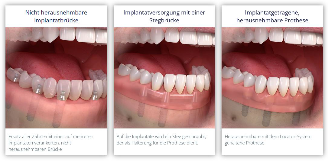 Behandlungsvarianten bei einem zahnlosen Kiefer.